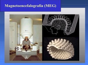 Magnetoencefalografía